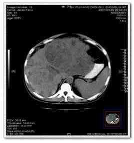 La ascites