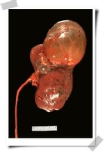 Quist renal