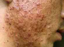 Atròfica acne