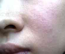 Barbs de l'acne