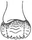 Rectocele
