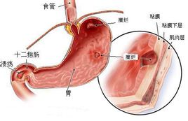 Gastritis hemorràgica