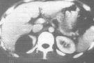 Quist renal esquerre