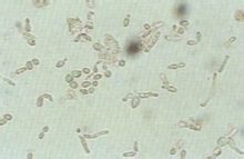 Esplenomegàlia