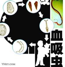 Malaltia hepàtica induïda Esquistosomiasis-