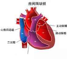 Malaltia cardíaca congènita