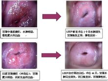 Hipertròfia cervical