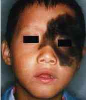 Nevus melanocítics