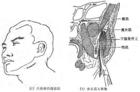 Infecció de l'espai masseter
