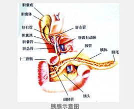 Pancreatitis aguda necrotitzant hemorràgica